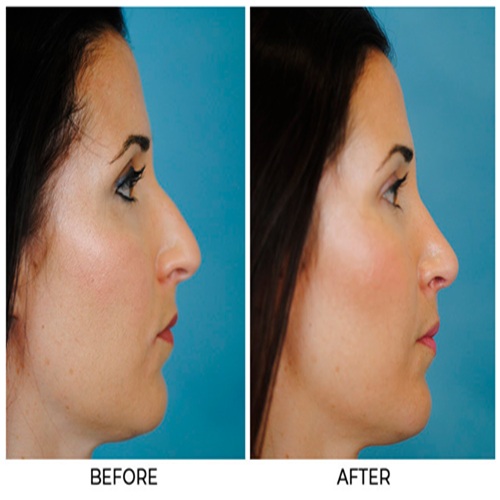Septoplasty & Turbinate Reduction