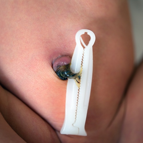 Hypospadias Repair