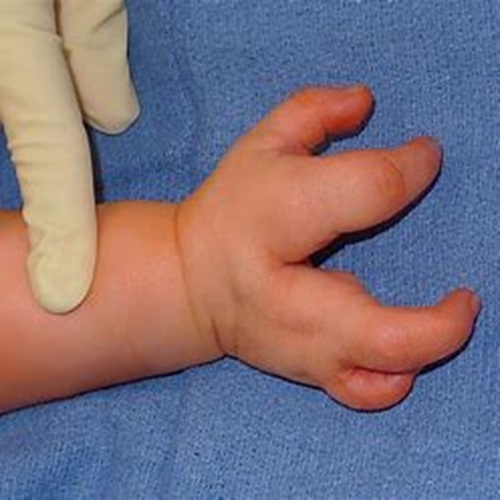 Congenital Hand Anomaly Surgery