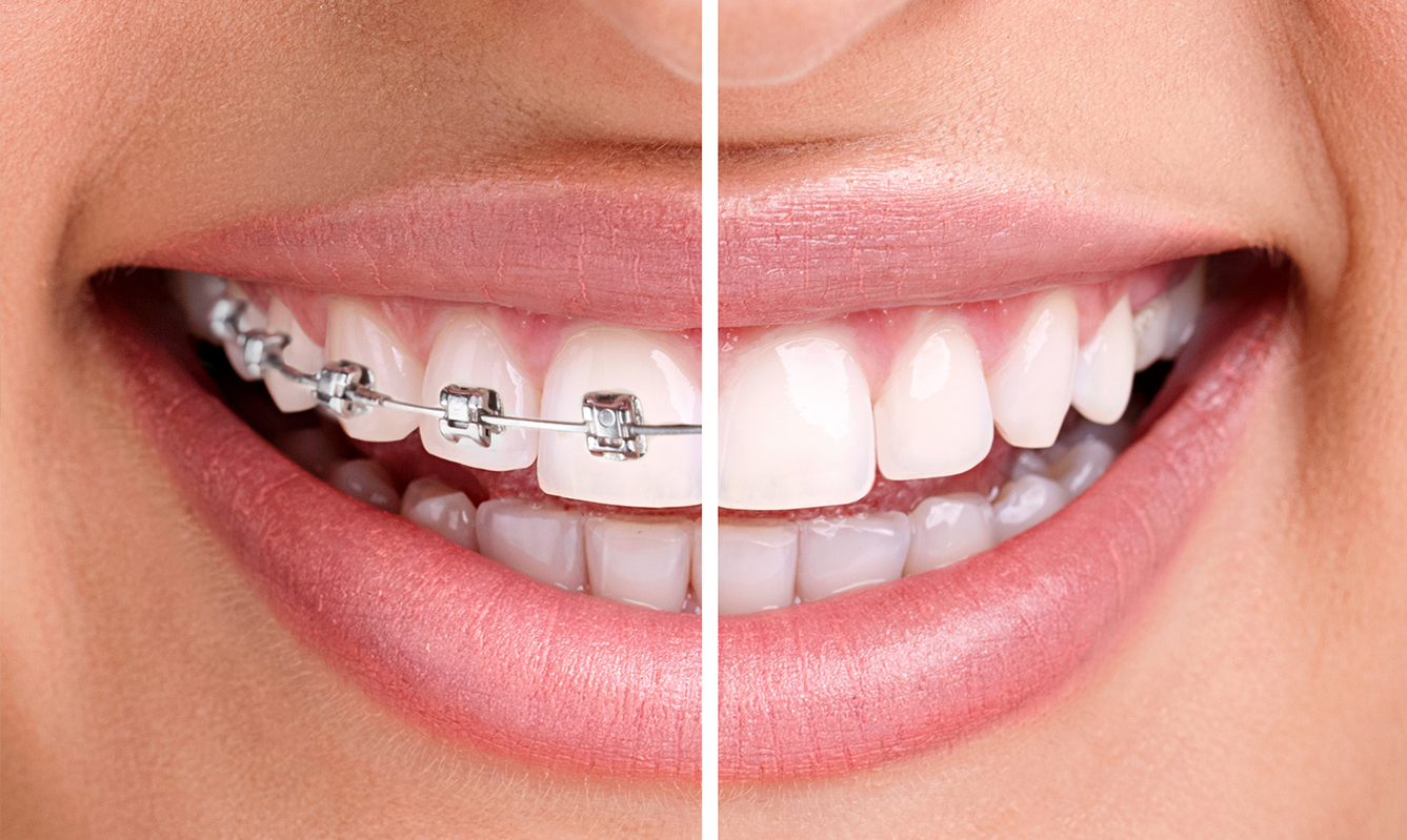 Why Metal Braces Are a Great Choice for Straightening Your Smile