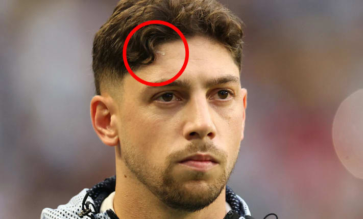 Federico Valverde scar spotted in Uruguay vs Saudi Arabia World Cup clash