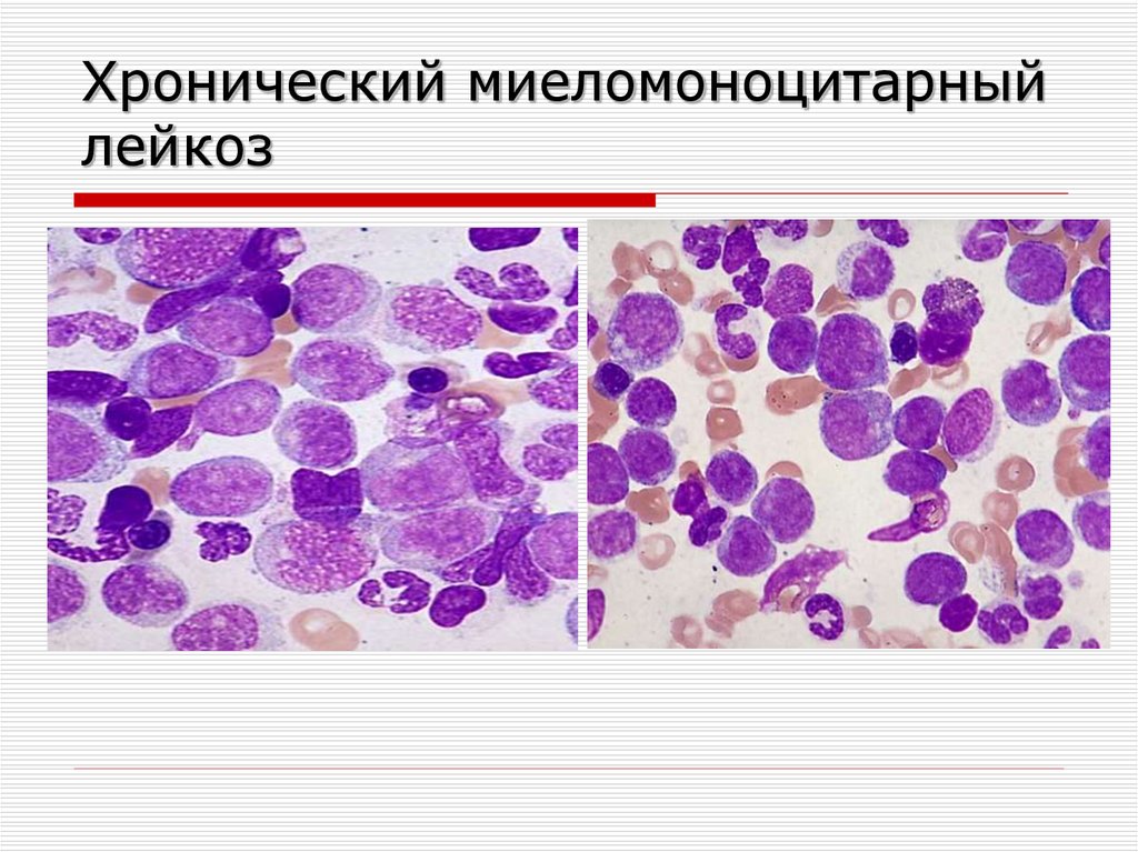 Картина крови при миелобластном лейкозе