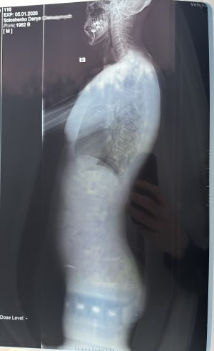 Lateral View X-Ray; January 2026