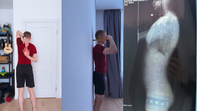 Day Zero of My Posture Experiment: X-Ray, Diagnosis, and the Plan