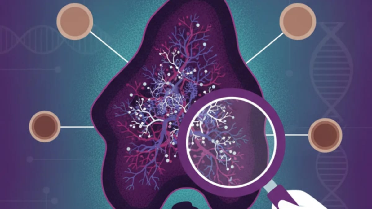 Melanoma: Why early detection is harder than it seems