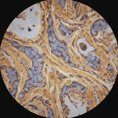 systemic-sclerosis-and-pulmonary-tuberculosis-risk
