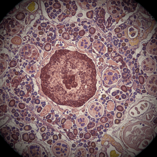 splenic-sarcoidosis-a-window-into-systemic-immunity