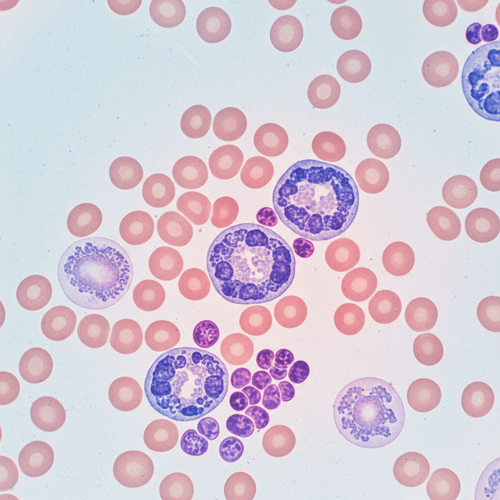 erythroblasts-in-b12-deficiency-an-ominous-sign