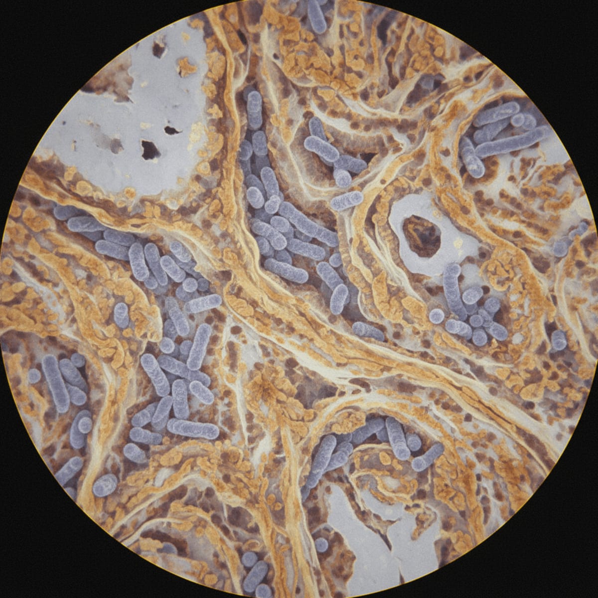 systemic-sclerosis-and-pulmonary-tuberculosis-risk