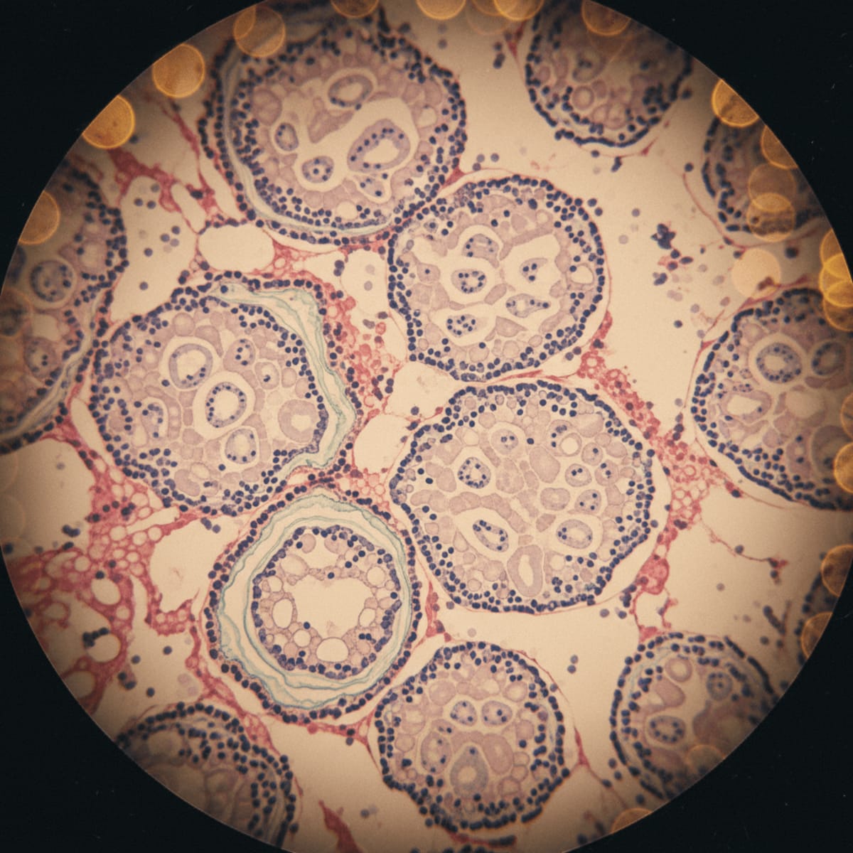 uncommon-presentation-the-diagnostic-challenges-of-splenic-sarcoidosis