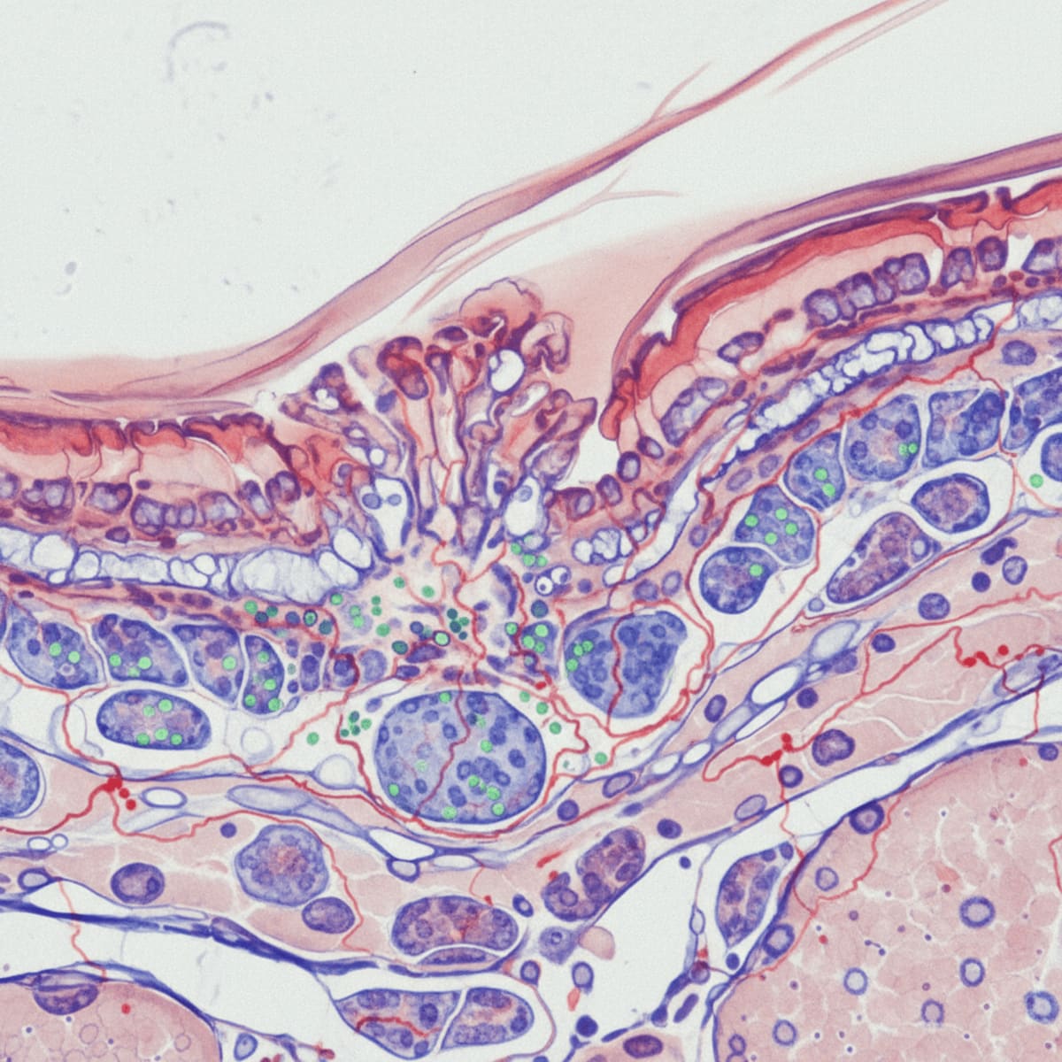unraveling-ichthyosis-immunodeficiency-linkages