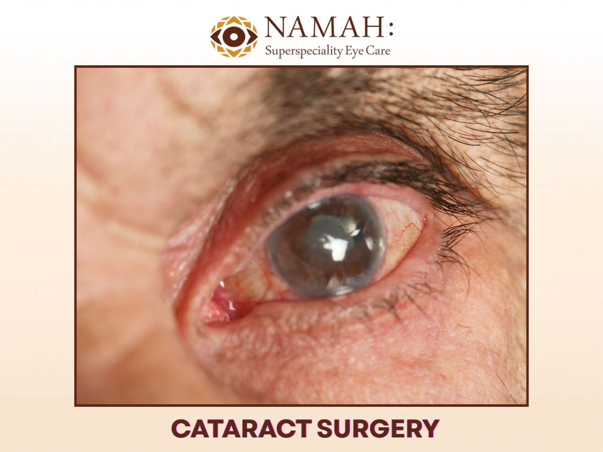 Cataract Surgery