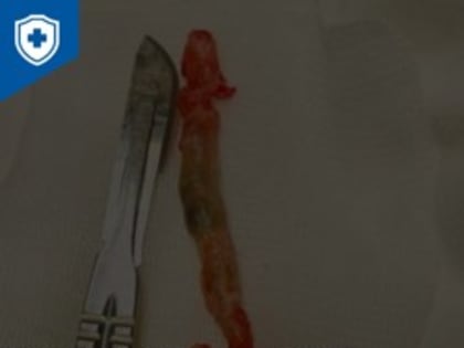 Псковские врачи провели сложную операцию и сохранили пациенту ногу