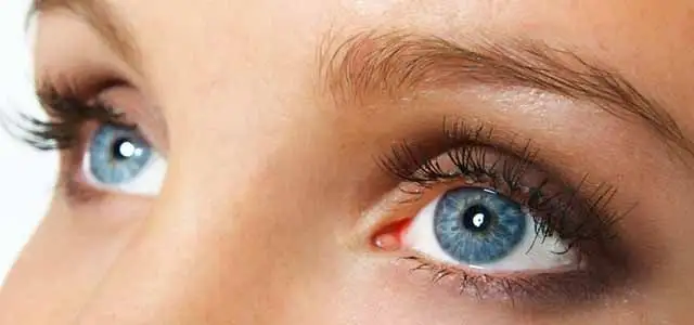 iridology