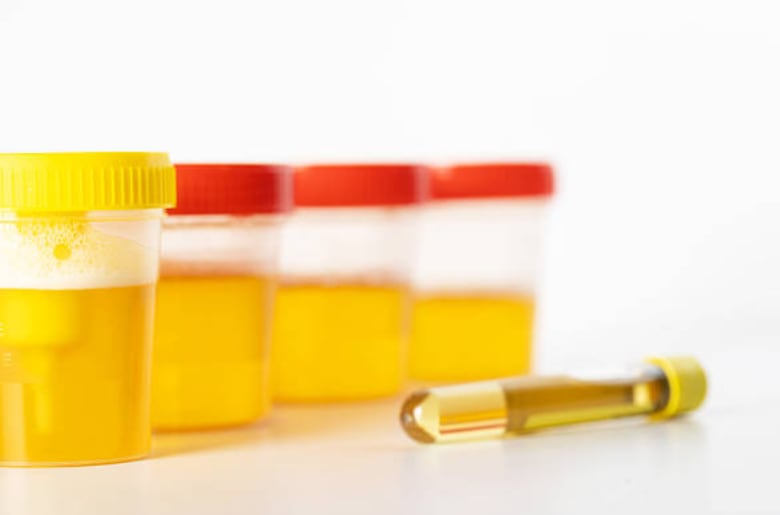 Recurrent urine infections in children Hyderabad Recurrent urine infections in children Hyderabad
