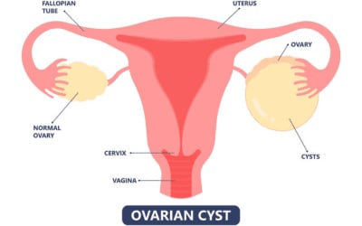 Ovarian Cyst Surgery Best Gynecologist in Hyderabad