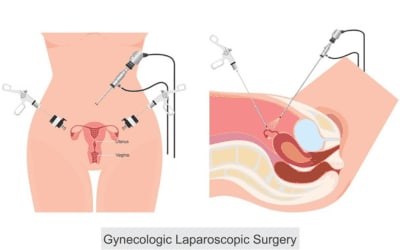 Laparoscopic Surgical Gynecology Best Gynecologist in Hyderabad