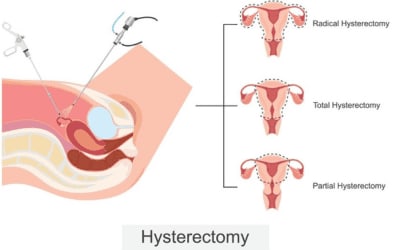 Hysterectomy