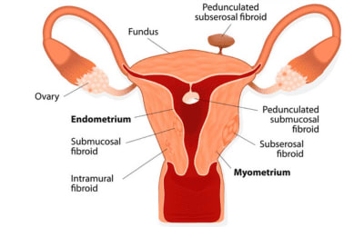 Fibroids Treatment Best Gynecologist in Hyderabad