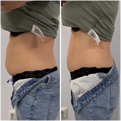 Comparație laterală a zonei abdomen și talie, două fotografii alăturate ale aceleiași persoane.