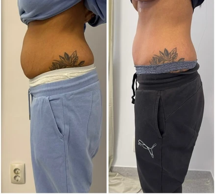 Comparație laterală a zonei abdominale inferioare, două fotografii alăturate ale aceleiași persoane.
