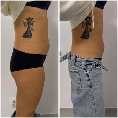 Comparație laterală a zonei talie și abdomen, două fotografii alăturate ale aceleiași persoane.