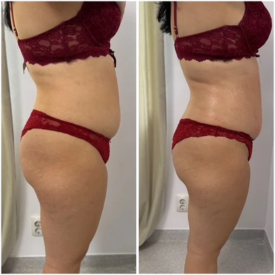 Comparație laterală a zonei abdomen și coapse, două fotografii alăturate ale aceleiași persoane.