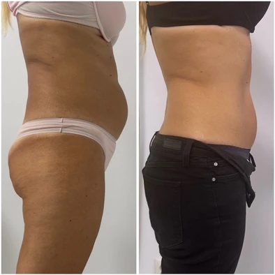 Comparație laterală a zonei abdominale, două fotografii alăturate ale aceleiași persoane.