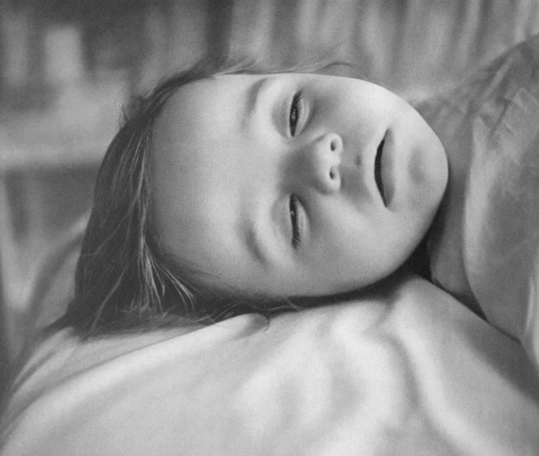 Child in deep anesthesia.