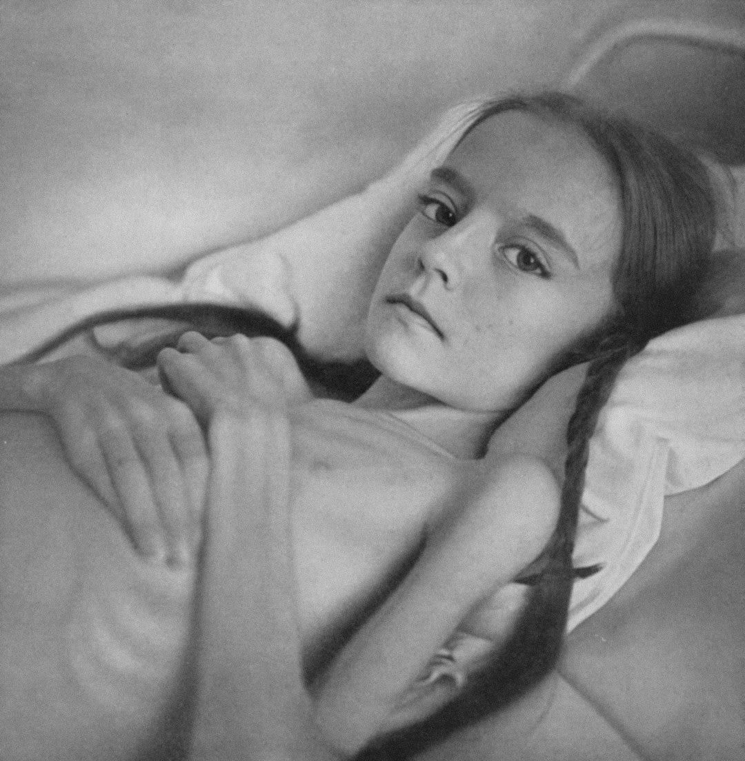 Multifocal osteomyelitis. Severe cachexia.