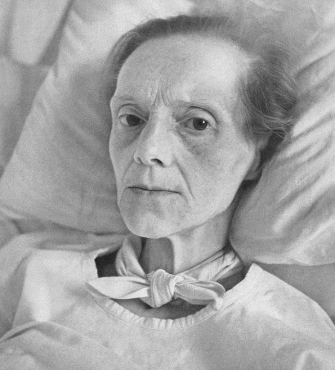 Stomach cancer. Severe cachexia.