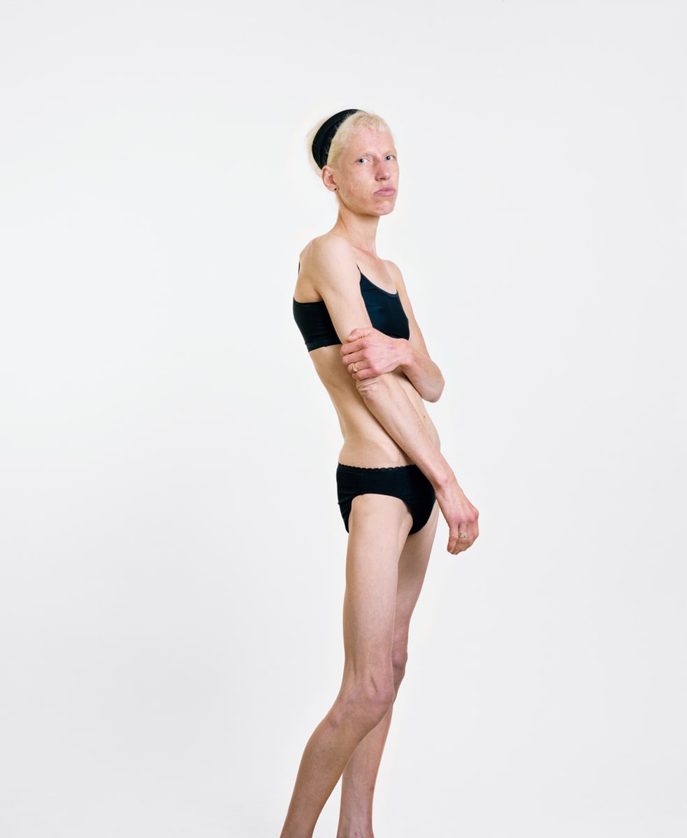 "I want to be thin. I was always very sporty at school. Now I am a skeleton."
Fiona Harris, 44.
Anorexic. 6.5 stone.
Winch...