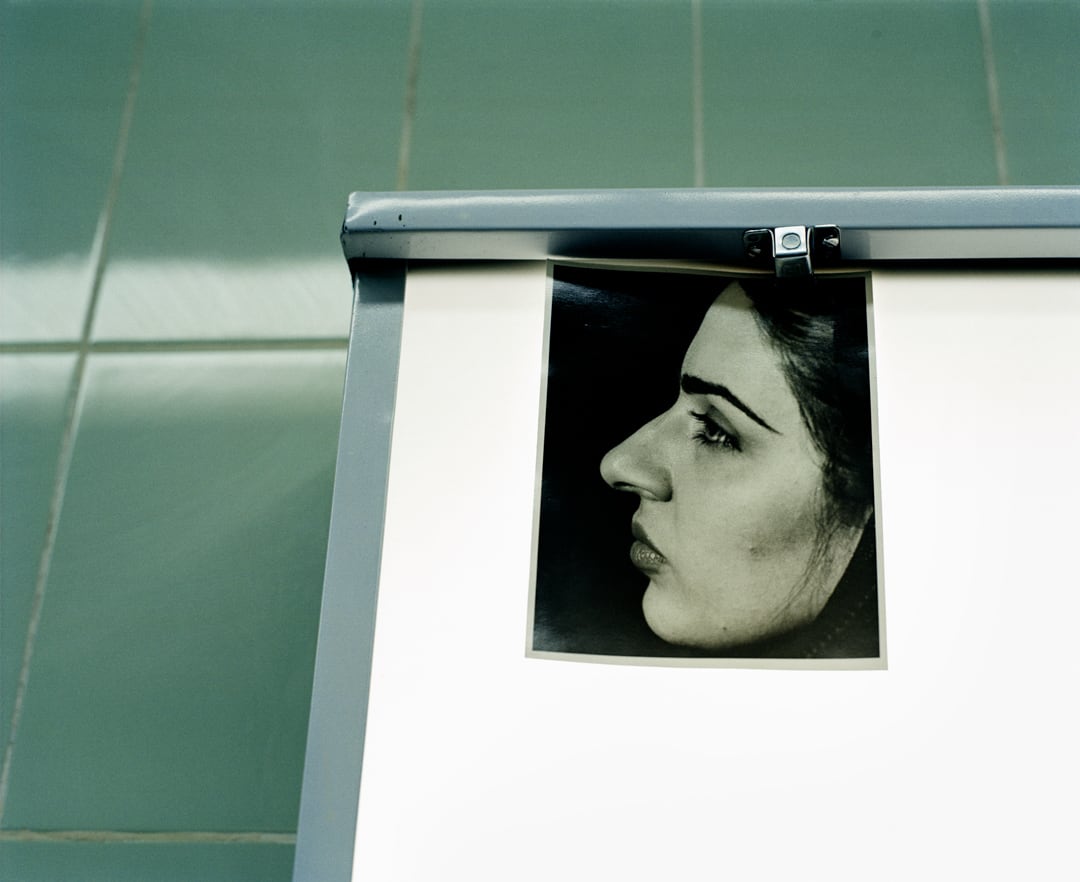 ‘Before’ photo. Rhinoplasty ‘nose job’ operation.
Tehran, Iran