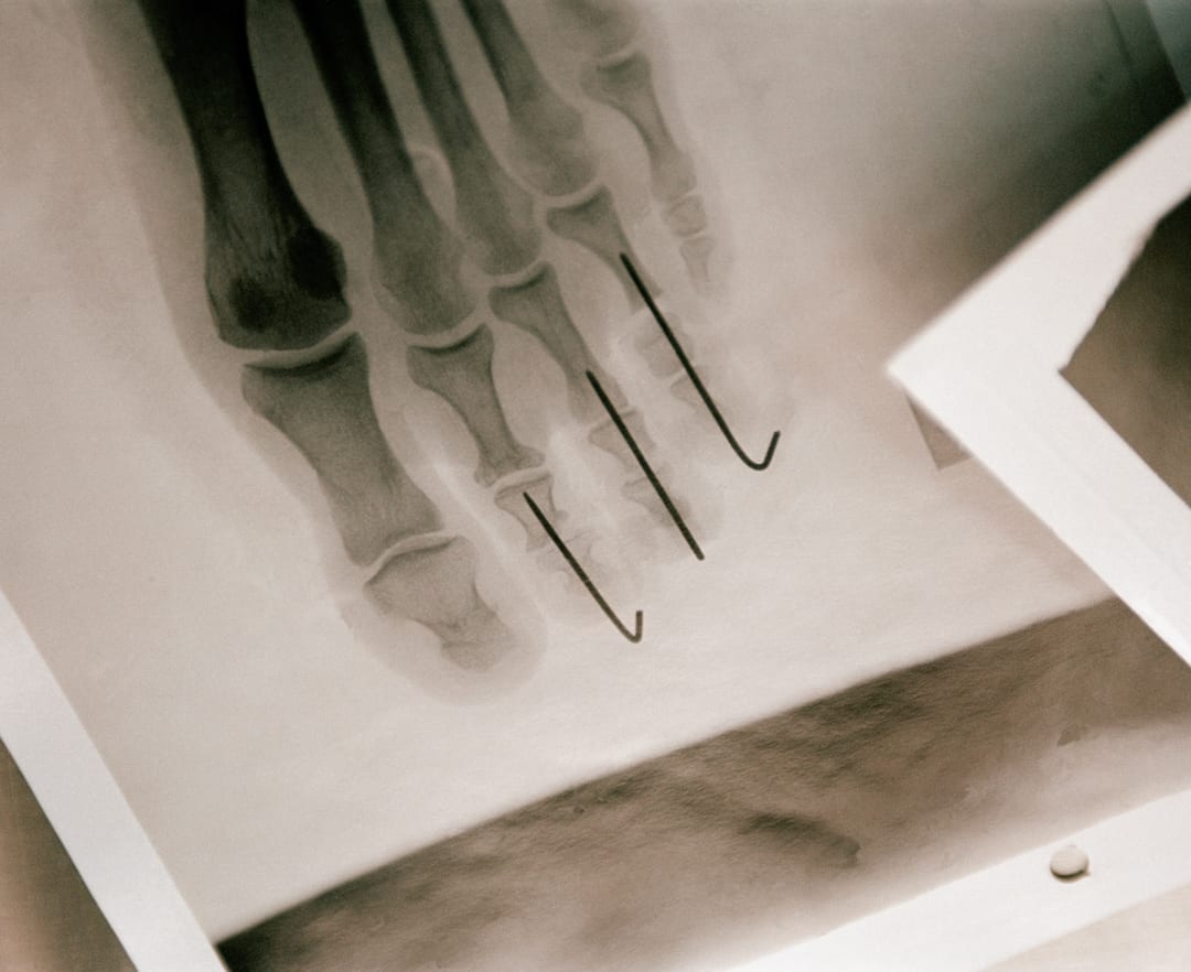 "I’ve had three toes shortened – a portion of bone removed between the joints and ﬁxed together with metal rods. I like to...