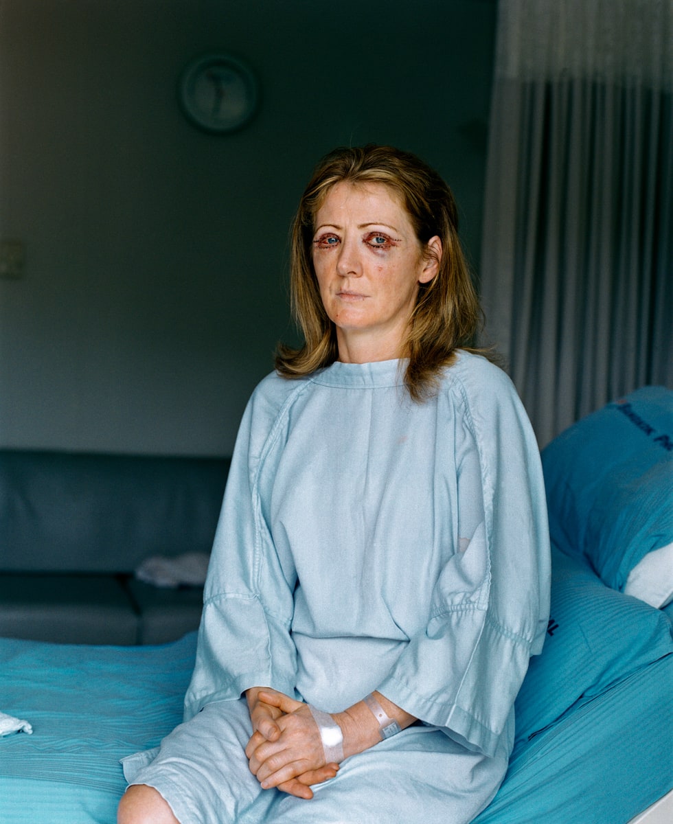 Barbara Mulkerrins, 42. Eyelid surgery and breast augmentation.
Bodyline cosmetic surgery resort.
Phuket, Thailand.