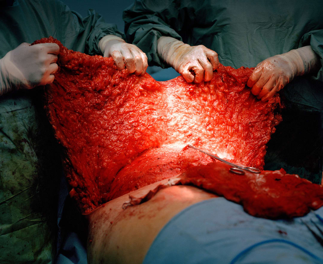 ‘Tummy-tuck’ operation. Kuala Lumpur, Malaysia.