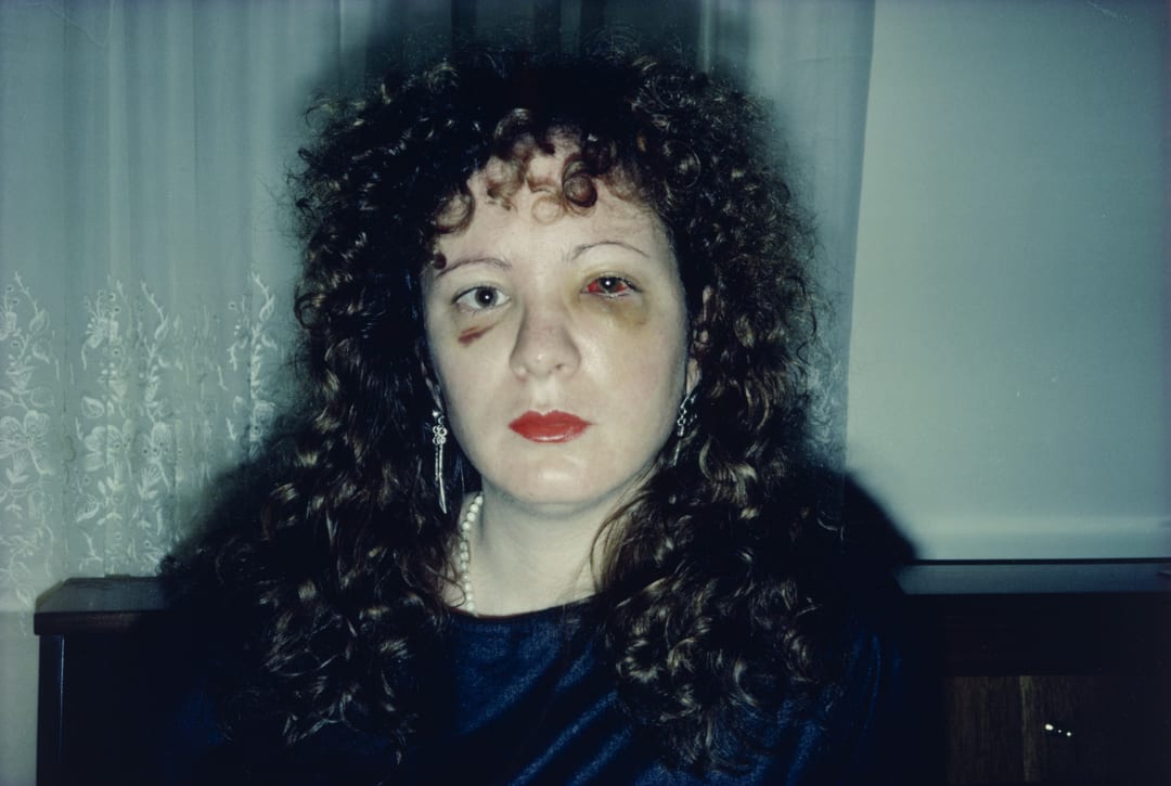 Nan One Month After Being Battered, 1984
