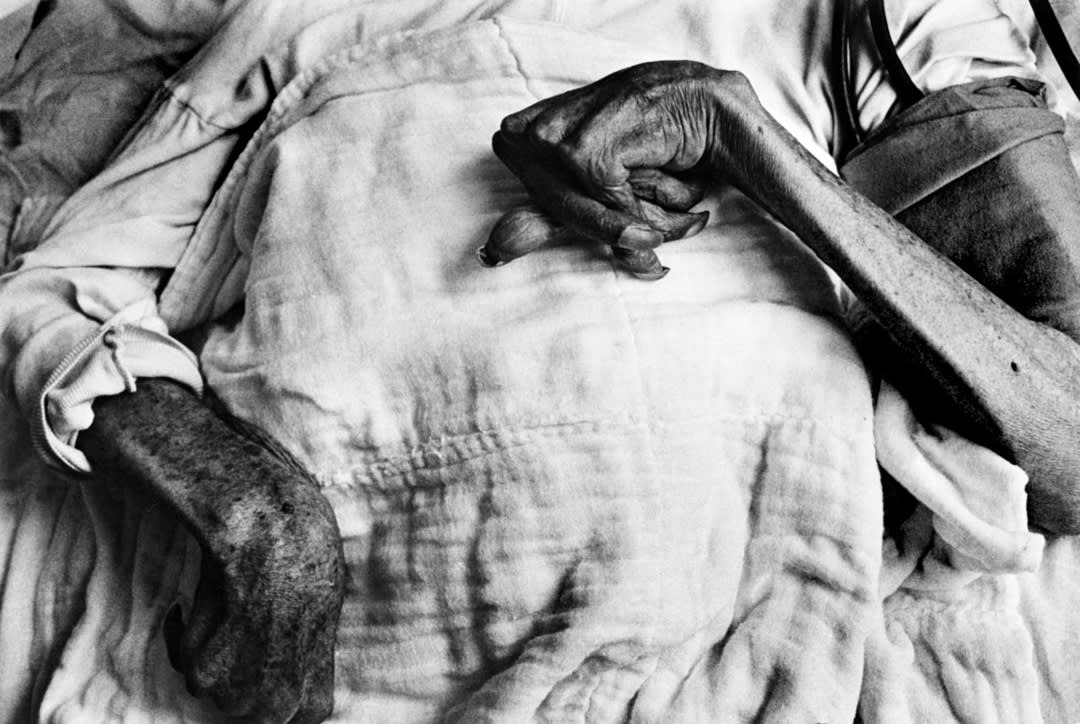Iwazo Funaba's crippled hands. She is a victim of the Minamata disease. Minamata, Japan. 1971 © W. Eugene Smith | Magnum P...