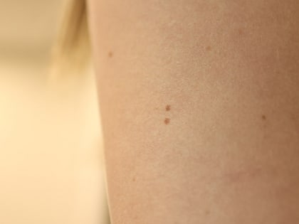 Челябинцев пригласили бесплатно проверить «подозрительные» родинки