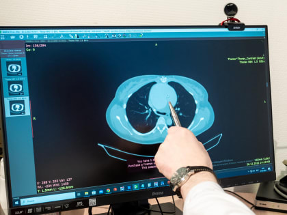 Кардиохирурги Челябинска избавили молодую маму близнецов от гигантской аневризмы аорты