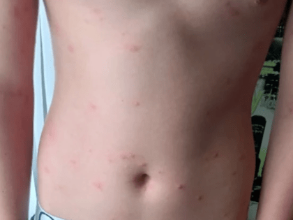 После купания на озере Банном под Магнитогорском у людей появилась сыпь