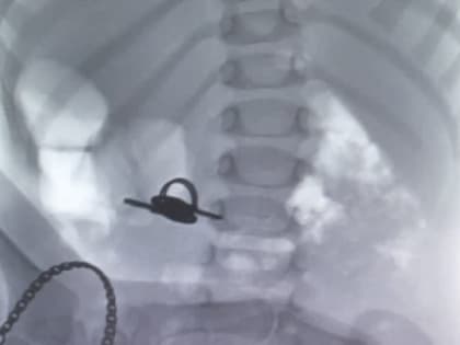 В ЧОДКБ из желудка малыша извлекли связку ключей