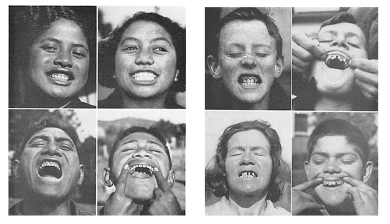 Black and white photos from Weston A. Price's research on pre vs. post industrial diets, showing significant dental crowding and weakening of the jawline with soft, modern foods
