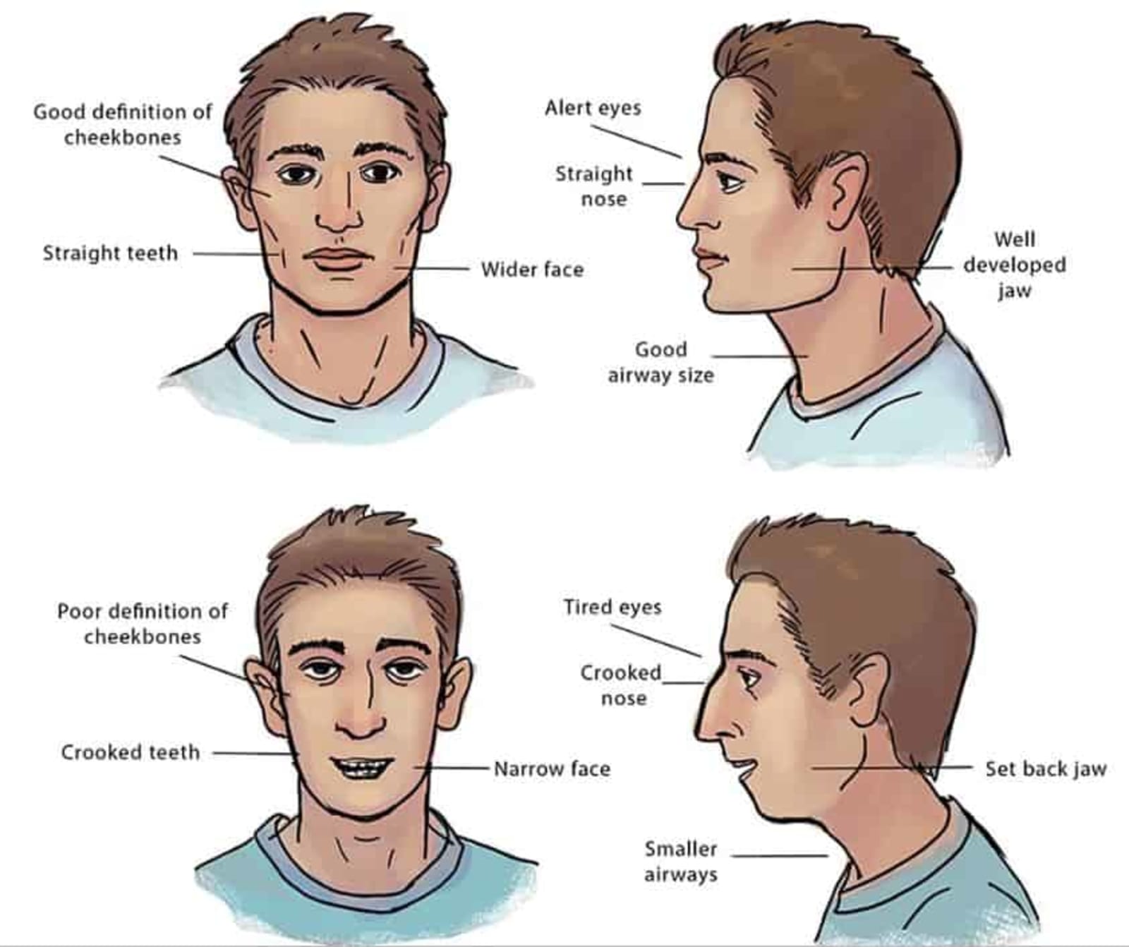 A diagram showing the facial features of mouth breathers vs nose breathers