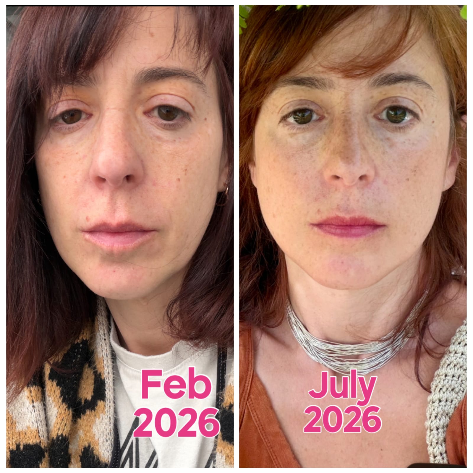 Before and after of a 47-year-old woman from the front, showing a lifted midface, softer jowls, and a firmer jawline after two months of chewing mastic gum daily