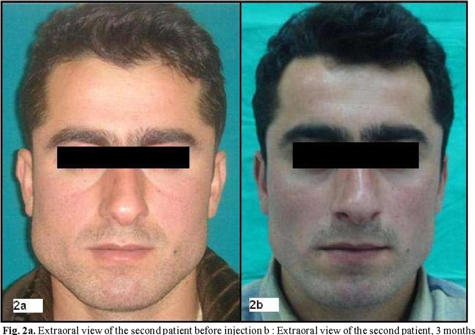 Before and after shots of a patient with bruxism, showing decreased jaw muscle size after injection with Botox