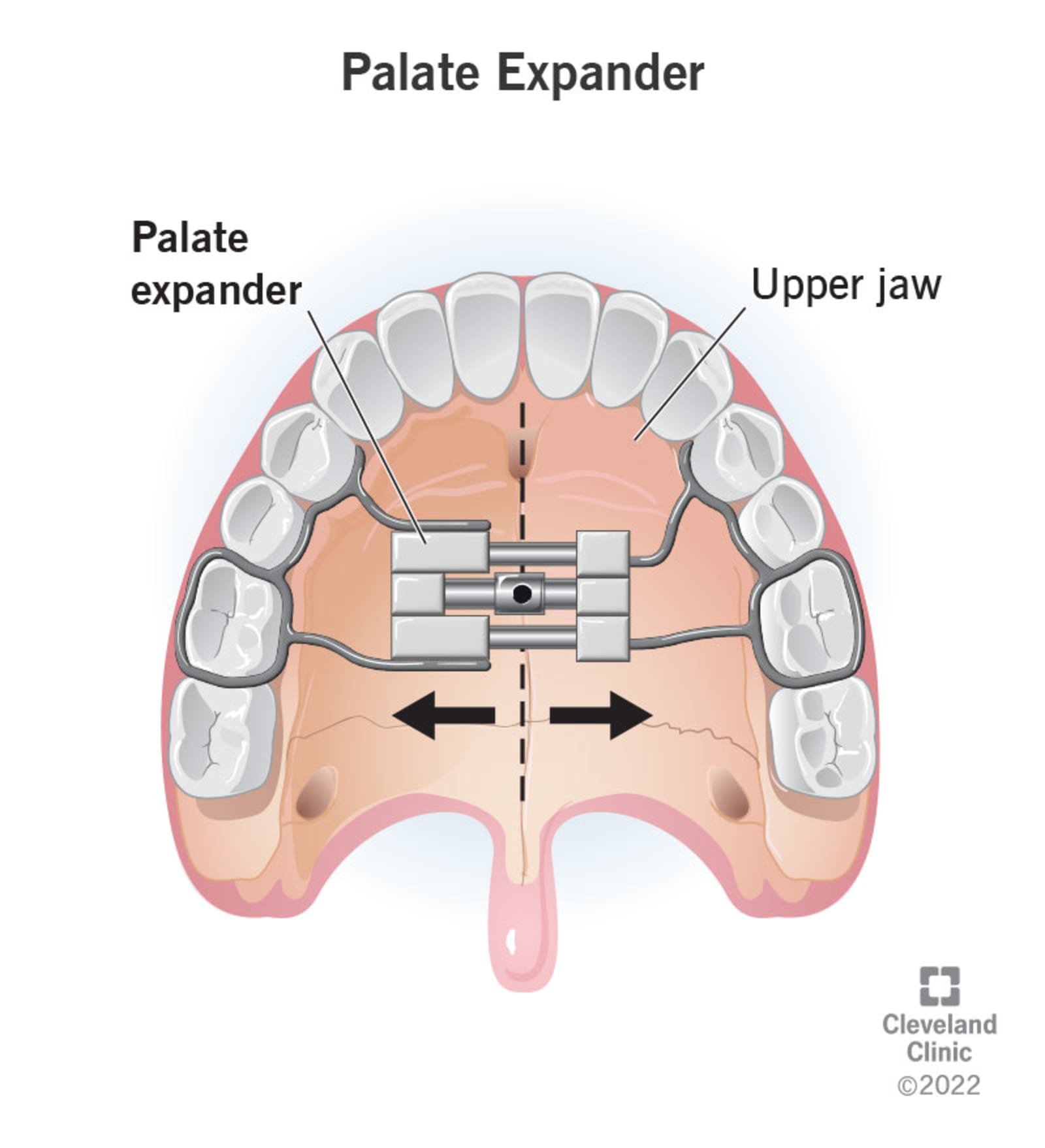 A diagram showing how a palatal expander works to expand the maxilla bone
