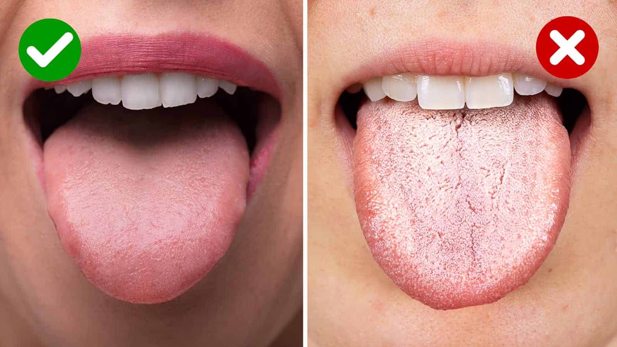 A healthy reddish-pink tongue compared to a whittish tongue