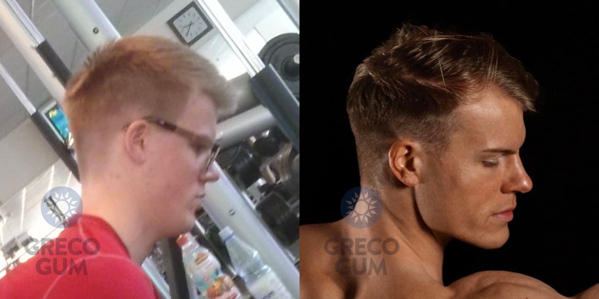 Before and after pictures of Marcel Schaar, showing his jawline improvement after a year of chewing mastic gum