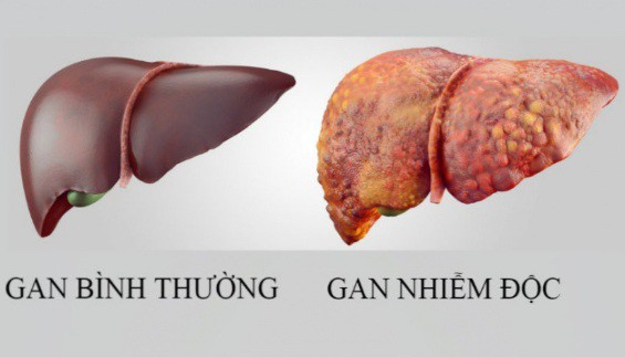 Loại quả mùa hè rẻ tiền, bán đầy chợ, người Việt ăn thường xuyên giúp làm mát liver, làm sạch gan nội tạng hiệu quả